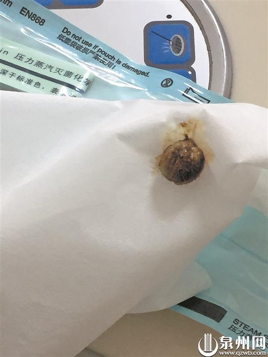 泉州:"臭鼻子"困扰男童3年 竟是异物藏鼻腔