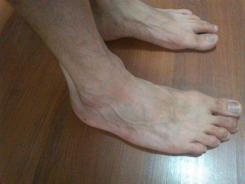 为什么有的人手上青筋多,有的人青筋少?有几个问题不得不注意