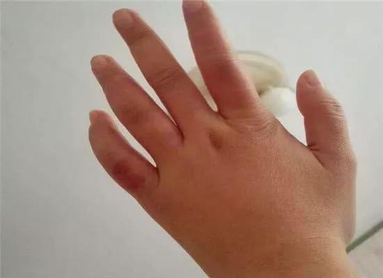 血糖|糖尿病_新浪新闻