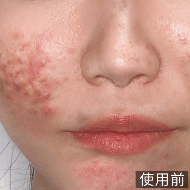 黑头闭口粉刺"杀手",火遍抖音的刷酸好物!一口气囤10瓶也不嫌多