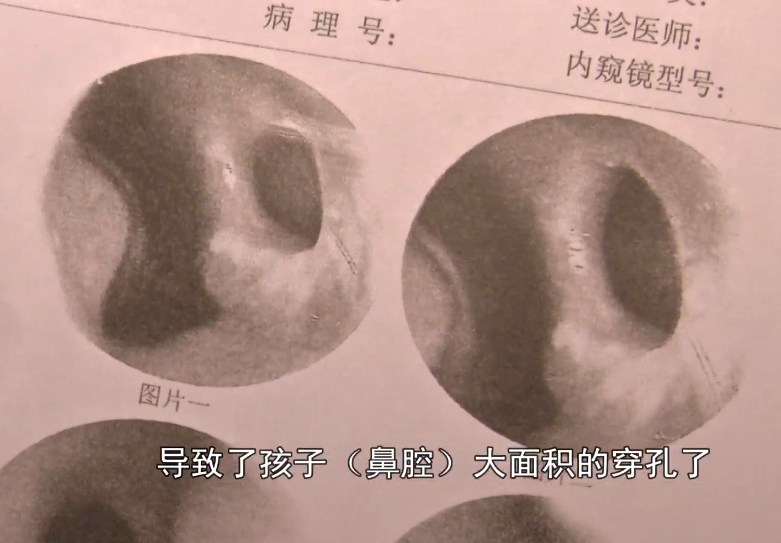 5岁幼儿鼻腔里流出咖啡色液体,家长用电筒一照,惊呆了!