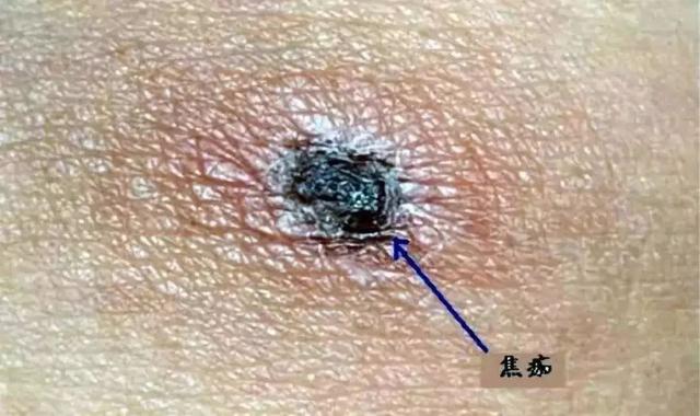 最近这种不明小飞虫出没,原来是…|恙虫|蜱虫_新浪新闻