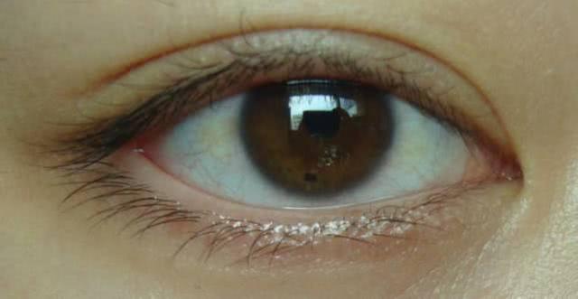 为何眼白部位会出现黑点真实原因有3个大人小孩不用惊慌