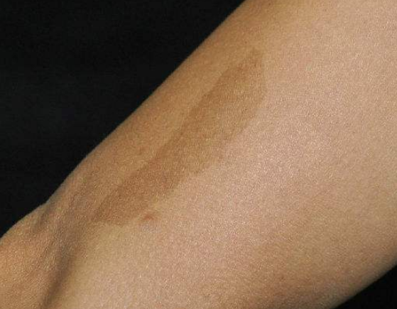 恕我直言,这2种胎记长哪都可能是祸根|恕我直言|色素痣_新浪新闻