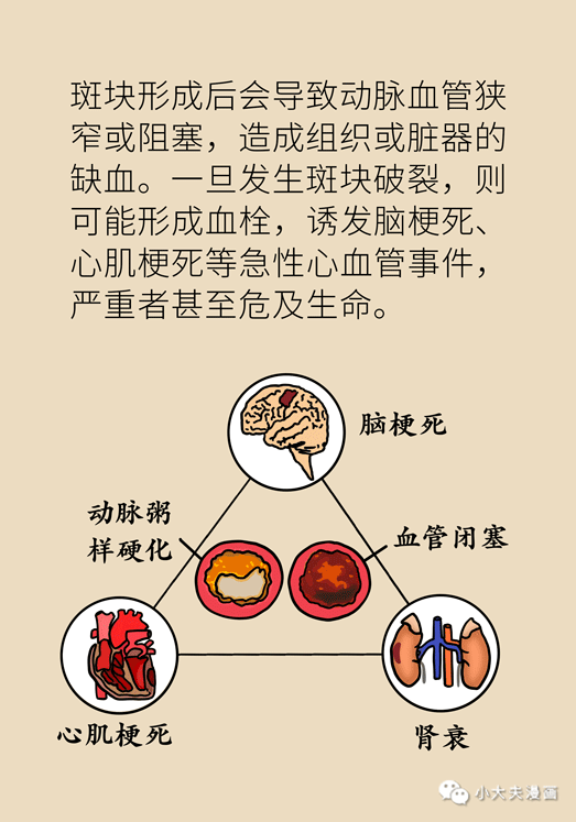 都是高血脂为什么医生给他的药方与给我的不一样
