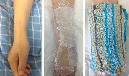 患者鼓针药物外渗了护士这样做才正确