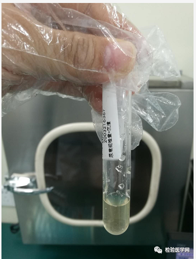 怎么回事?"果冻"样的尿液标本你见过吗?