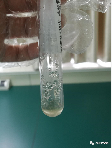 怎么回事?"果冻"样的尿液标本你见过吗?