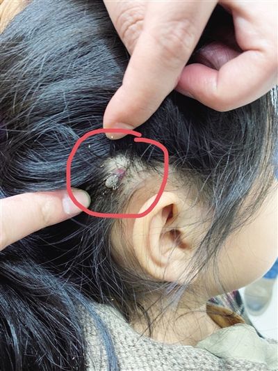 女童外出游玩时,蜱虫钻入表皮 医生:春暖花开季 外出游玩警惕蜱虫叮咬