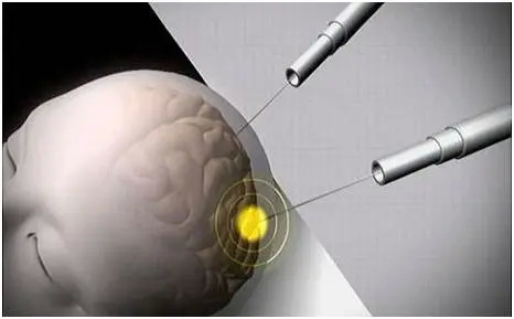 可穿戴设备控制脑电波改变情绪不如监测情绪靠谱