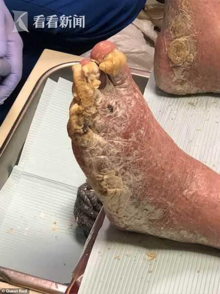 男子多年不修脚趾甲 长满指甲真菌 医生从未见过