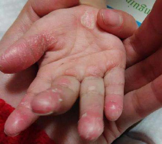 孩子手脱皮除了干燥之外,其实还和三种的疾病有关,我们可以来看看.