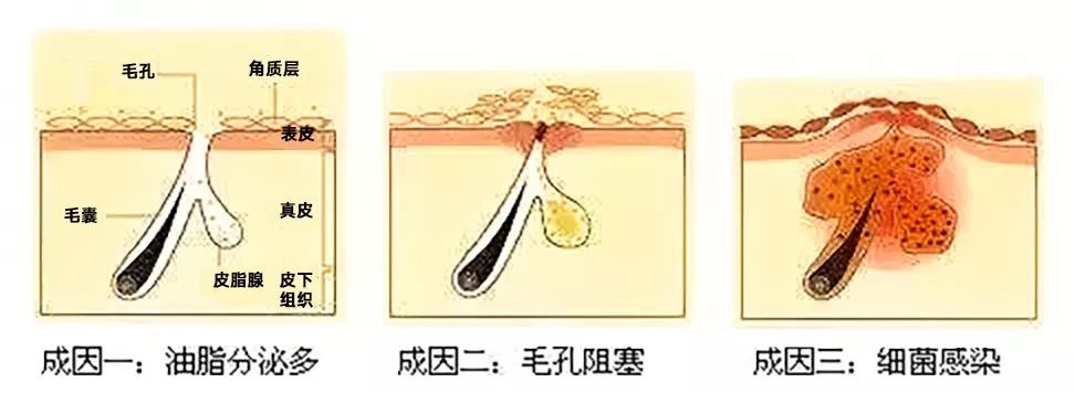 上图中连着毛发的就是毛囊,毛囊左右两边的分叶状的东西就是皮脂腺.