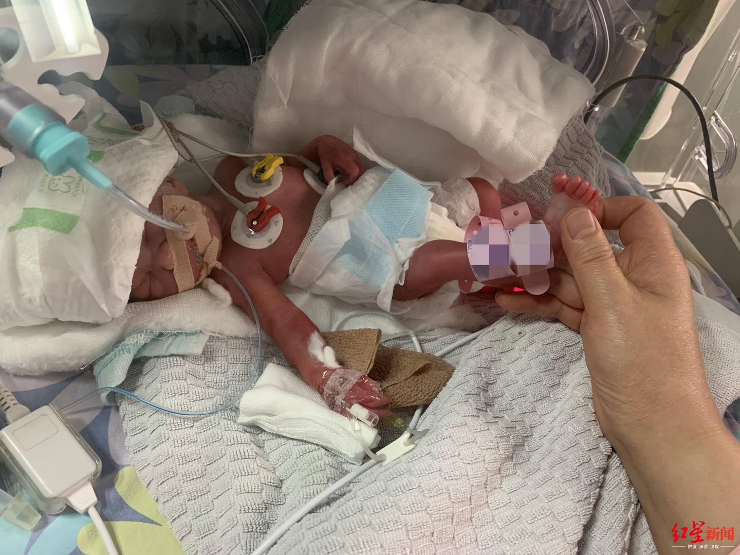 早产双胞胎姐妹出生仅2斤 父母:只要她们能活下去,一定竭尽全力