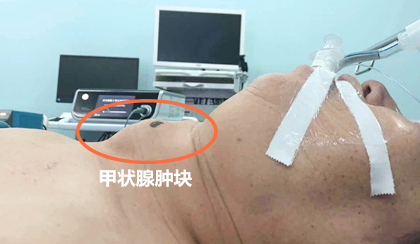 西安大兴医院为患者摘除长了29年的甲状腺肿瘤西部网 2020-04-24 14