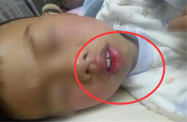 平时睡觉张着嘴巴导致的,长期张嘴睡觉非常容易导致牙床变形,嘴唇外翻