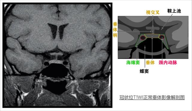 正常垂体的MRI表现|解剖学|血管_新浪新闻 正常垂体的MRI表现|解剖学|血管_新浪新闻