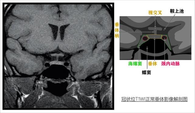 垂体解剖结构 MRI图片