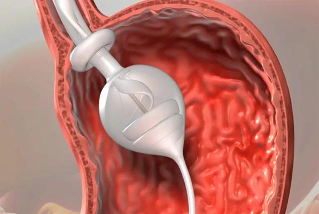控制食物出入的减肥胃水球transpyloricshuttle