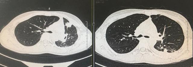 破坏力堪比新冠,能让支气管只剩1毫米缝的这病,连林黛玉都得过|肺结核