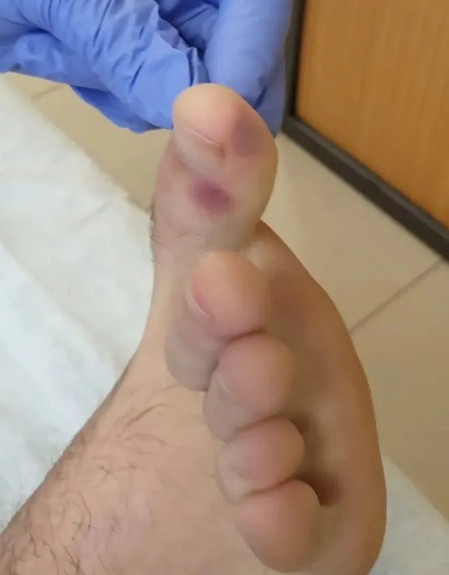 送进icu后查出新冠阳性!新症状出现!|川崎病|血管|新冠肺炎_新浪新闻