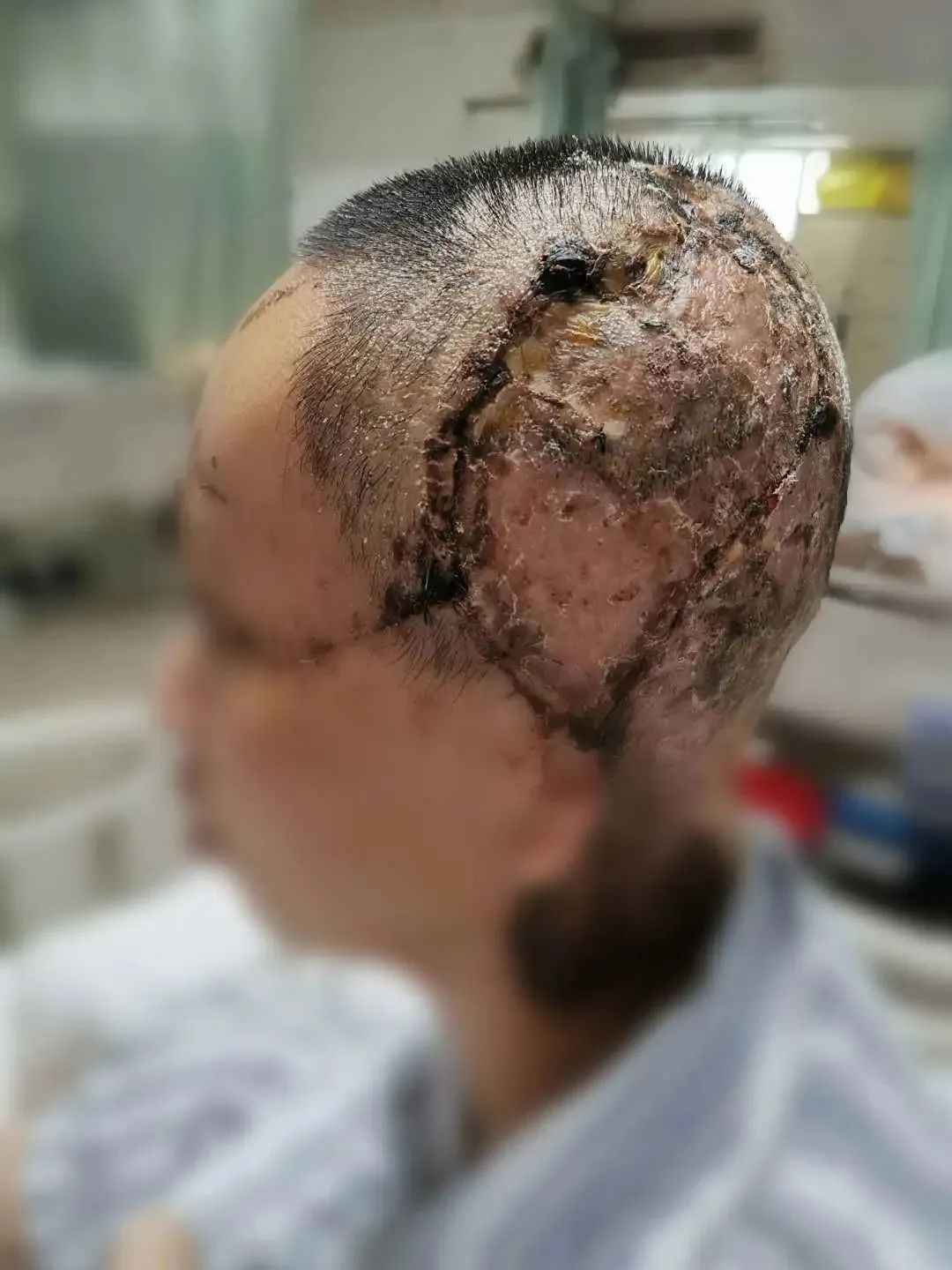 惠来一女子长发卷入机器,整张头皮瞬间被撕扯下来