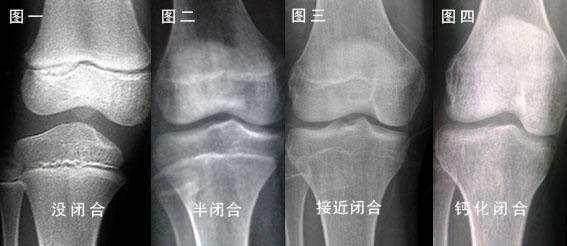 藏着两大危害1,易导致孩子性早熟儿童长高主要是依靠人体骨细胞分裂