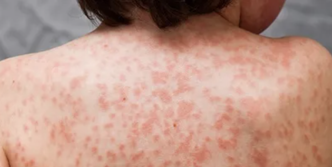 川崎病是一种全身血管发炎的疾病,最常见的症状为发烧超过5天,颈部