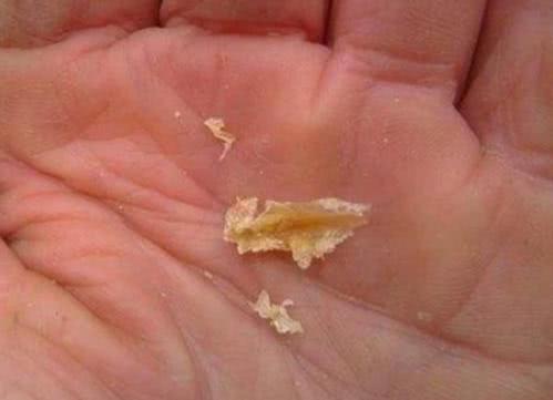 为什么耳朵发痒没完没了,却掏不出耳屎?别忽视一种原因