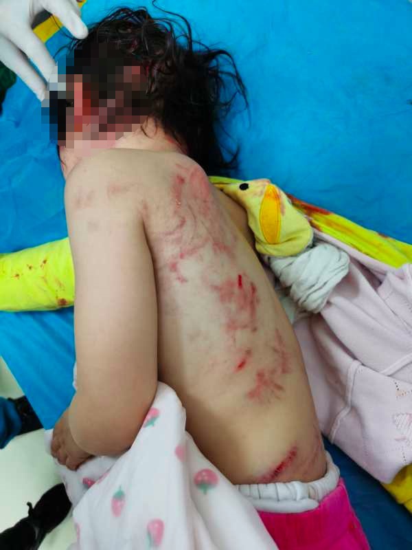 女童身上有大量咬的伤痕。家属供图