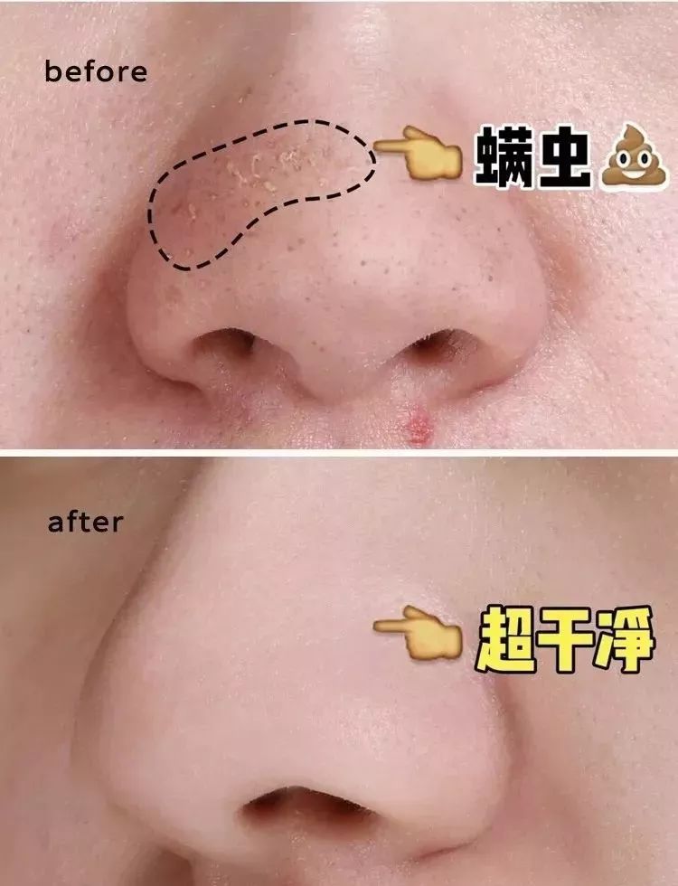 螨虫脸治疗方法图片