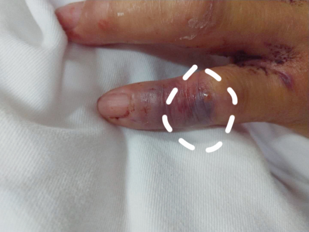 可怕!福建一男子杀鱼时手被刺伤,竟不幸离世!