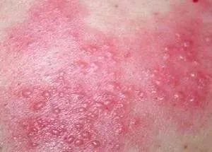 实用干货:12种常见皮肤病分辨口诀
