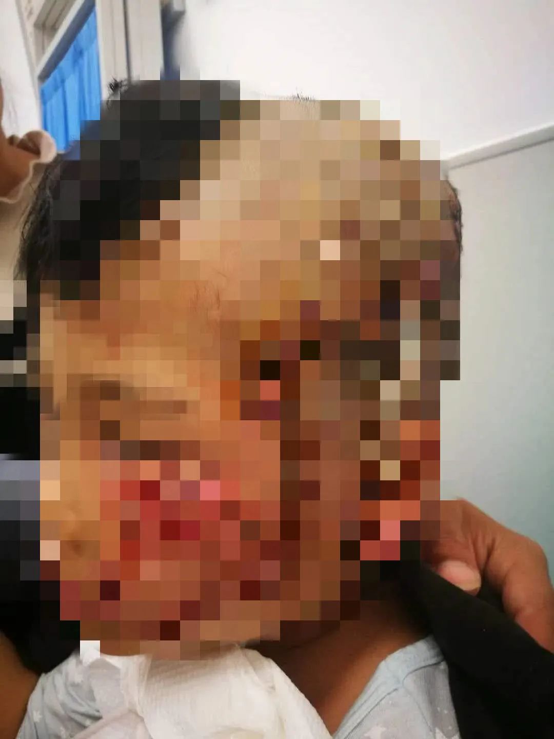 恐怖5岁男童被恶犬撕咬6分钟伤口裂到后脑勺最长15厘米