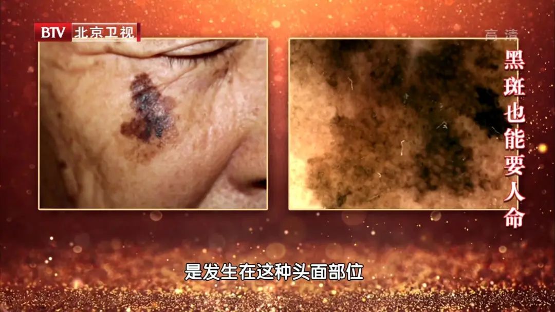 这三种斑,不痛不痒却可能是癌症信号!45岁以上的人要留神