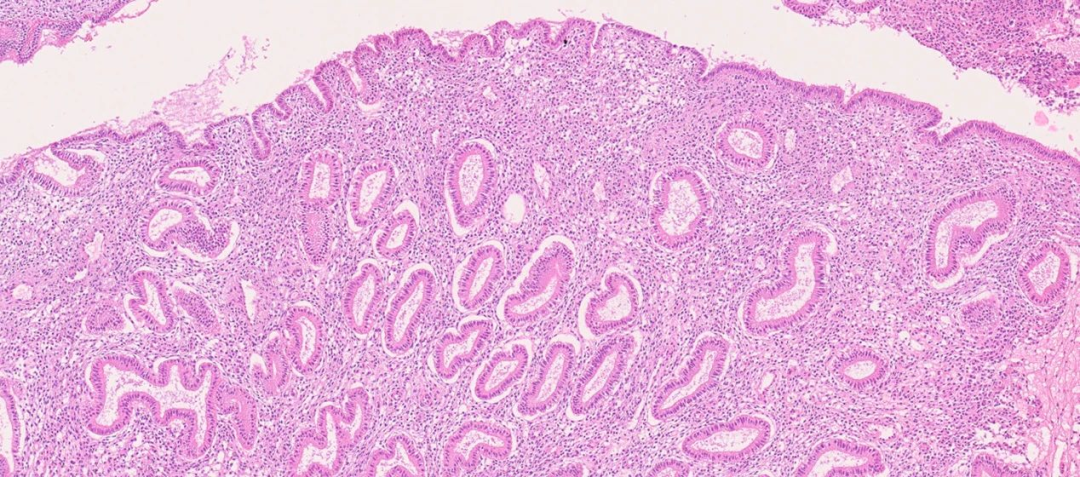 英国自然杂志健康子宫内膜也会突变致癌8类人做好早期筛查
