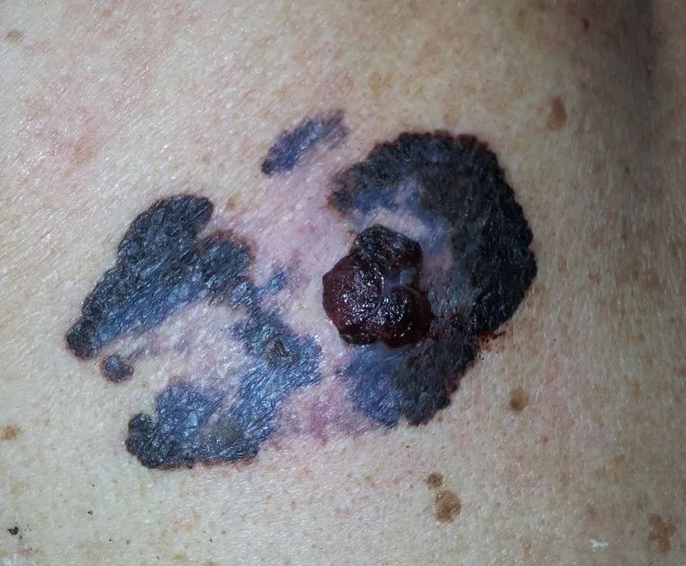 北大医生提醒:身上长这5种痣的人要注意