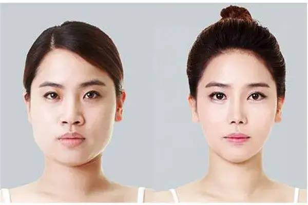 8w块徒手整骨出的鞠婧祎同款小v脸,只维持了10小时