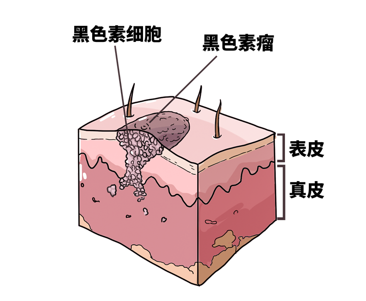 痣也有可能会癌变出现这些症状要当心