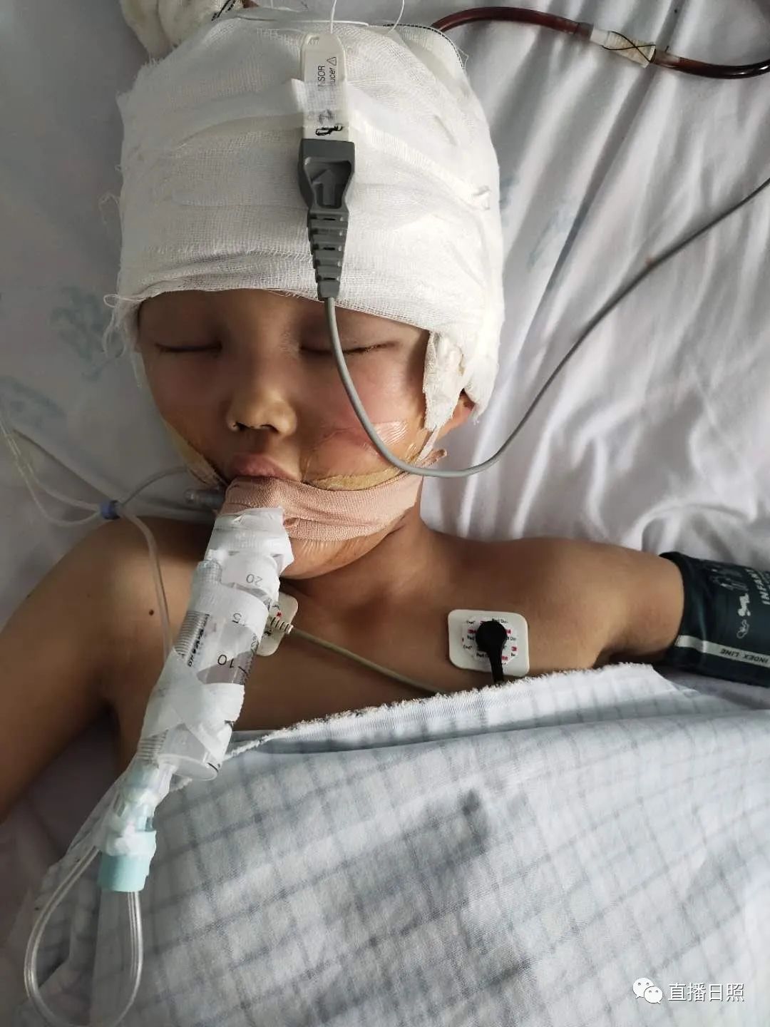 窗户坠落砸中日照7岁女孩头部头骨粉碎性骨折急需大家帮忙