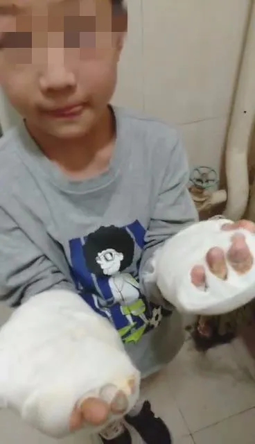 男童手上缠着纱布。