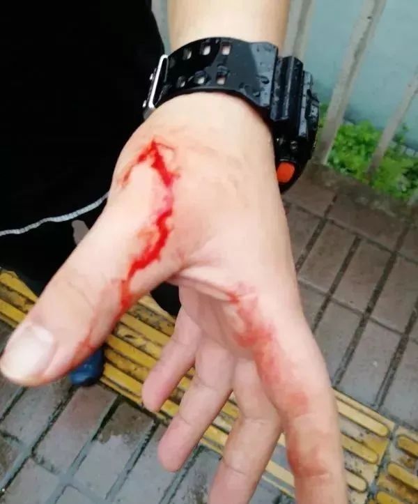 准备在"520"求婚的他,被毒贩刺中胸膛,刀尖距离心脏仅0.5厘米