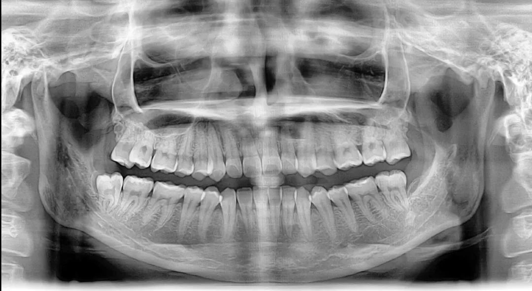 正常牙齿侧面x光片图片