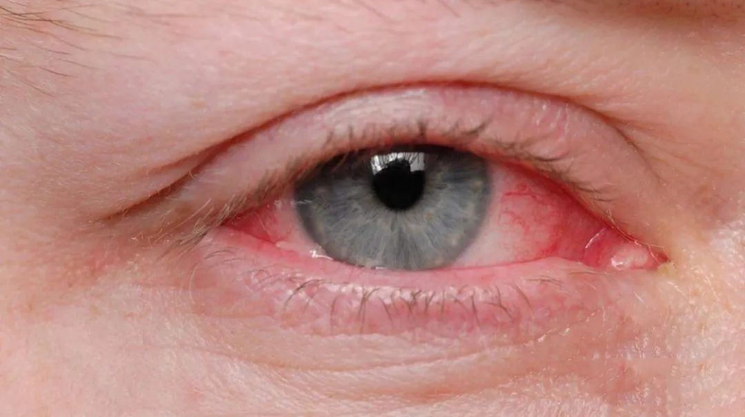 解读新冠病毒最新研究看红眼识病人戴眼镜防感染