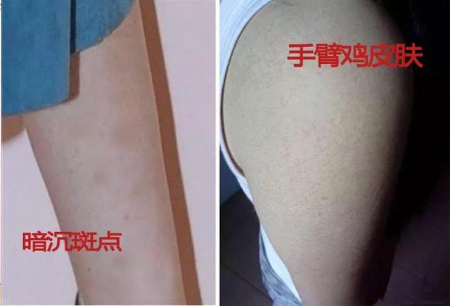 男士鸡皮肤每天洗澡好吗(鸡皮肤可以经常洗沐浴露吗) 男士鸡皮肤每天洗澡好吗(鸡皮肤可以经常洗沐浴露吗)