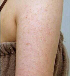 鸡皮肤后背痘(后背长痘跟鸡皮一样是什么原因)