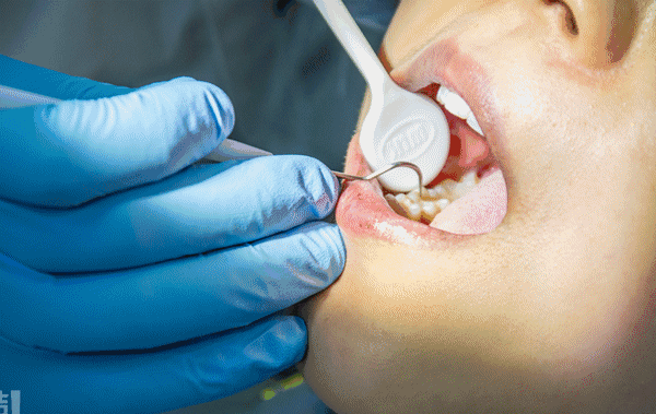 下面就是重头戏洗牙,无刺激清洁,保证牙齿不受二次伤害,让你轻松获得