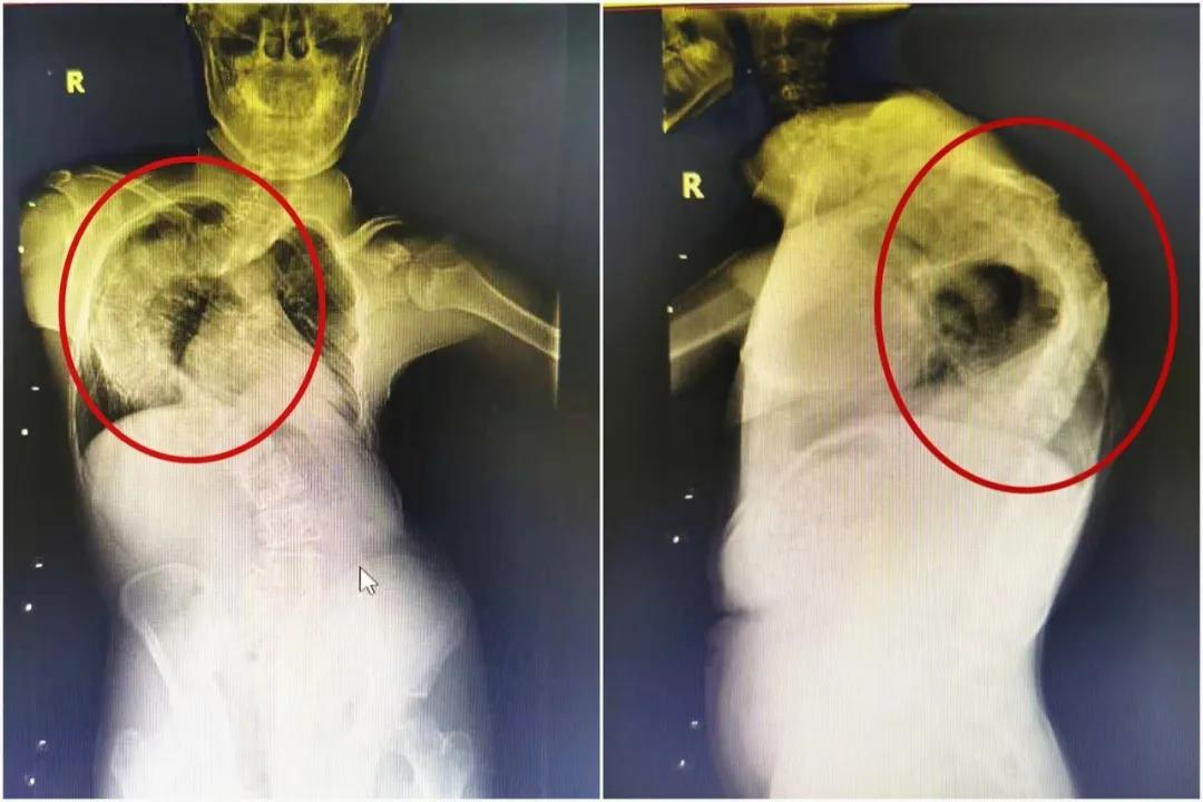 贫困少年脊柱侧弯超过100度每天进行十多个小时牵引治疗