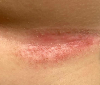 川崎病|疾病|新冠肺炎_新浪新闻