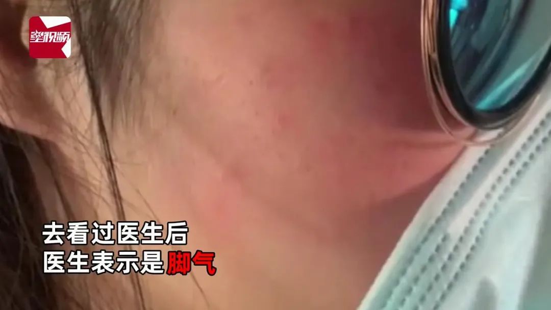 铲屎官的脸上竟然长了脚气?